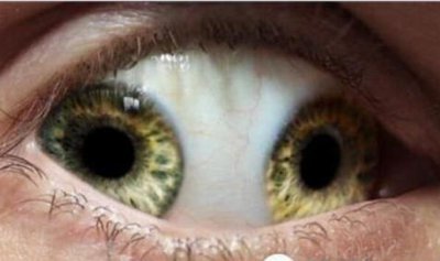 ​世界上有双瞳的人吗，双瞳孔是真实存在(我国就有不少)