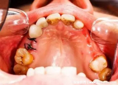 ​一次拔两颗智齿后悔死了，有人拔牙之后得了干槽症痛不欲生